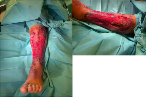 Figure 3 Image of the lower limb during surgery.
