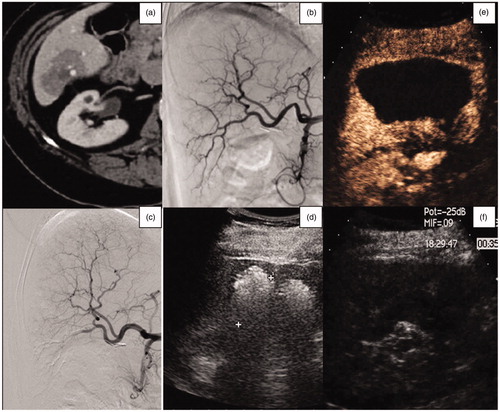 Figure 4. (a) Axial CT-image of a 74-year-old woman, showing a breast metastasis in the VI hepatic segment. (b, c) Selective diagnostic hepatic angiography, showing the hepatic vascularization of the right lobe and the embolization of the vessels feeding the liver metastasis. (d) US-monitoring of the subsequent MWA procedure. (e, f) US contrast-image performed 6 months after the TAE-RFA procedure, showing a large area of necrosis and no residual tumor.
