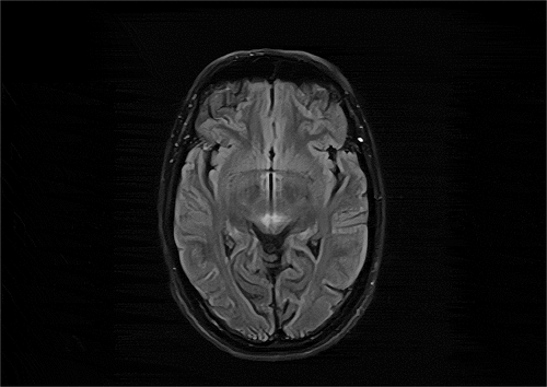 Figure 2. Hypersignal change in dorsal midbrain in axial FLAIR.