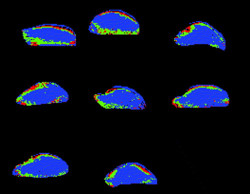 Figure 2.  Regions with different vascular characteristics defined in the eight 200 mm3 KHT tumours. Red, green, and blue areas are regions with initially high, medium, and low IAUC, respectively.