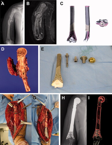 Figure 4. Humeral reconstruction. Images of patient #10. (A) A preoperative plain radiograph and (B) a T2-weighted MR image showing osteosarcoma in most of the humerus, except the elbow joint. (C) Graphical designs of the 3D-printed implant. (D) Resected bone tumor as planned. (E) Photograph of the 3D-printed implant and tumor prosthesis to be used. Intraoperative photograph showing (F) proximal and (G) distal parts of the reconstruction. (H) A postoperative plain radiograph and (I) CT reconstruction image showing humeral reconstruction.