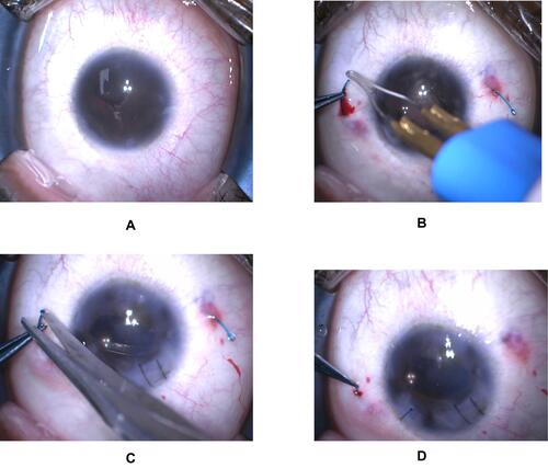 Figure 1 (A) scleral fixation using Yamane technique, (B) securing the haptics with cautery, (C) haptics trimming, (D) placing haptics in the scleral tunnel.
