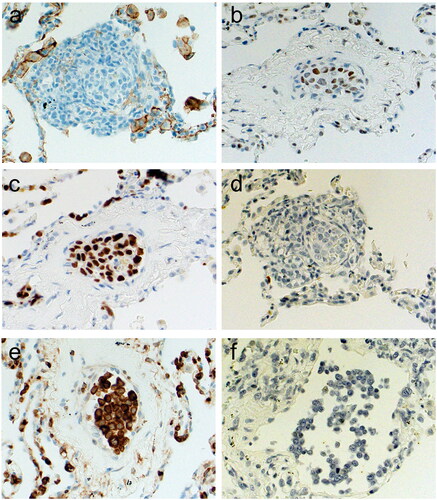 Figure 4. Histopathological findings of lung tissue in an autopsy. (a) CD10, (b) BCL6, (c) MUM1, (d) CD5, (e) BCL2 and (f) in situ hybridization EBERs. According to the cell of origin classification, neoplastic cells were non-GCB type (CD10−, BCL6+ and MUM1+). Furthermore, these cells were BCL-2-positive, CD5-negative and in situ hybridization EBERs-negative.