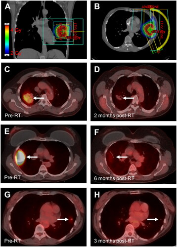Figure 1. Response to very low-dose radiotherapy. (A,B) Coronal (A) and axial (B) images demonstrating the radiation plan for a 67-year-old woman with stage IE BALT lymphoma of the left upper lobe treated with 4 Gy in 1 fraction. Color wash shows radiation dose. (C,D) PET/CT images in a 64-year-old man with stage IE BALT lymphoma of the right upper lobe (RUL) before (A, SUV 3.8) and 2 months after treatment with 4 Gy in 2 fractions (B, SUV 1.2). (E,F) PET/CT images in a 60-year-old woman with recurrent BALT lymphoma of the RUL before (C, SUV 10.1) and 6 months after treatment with 4 Gy in 2 fractions (D, SUV 1.9). (G,H). PET/CT images for the patient shown in (A, B) before (A, SUV 1.6) and 3 months after radiotherapy (F, SUV 0.6).