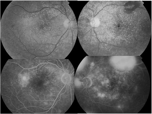 Figure 5. In the fundus examination, in the bottom two pictures, preretinal, intraretinal, and intravascular diffuse oxalate crystals decrease after 18th month.