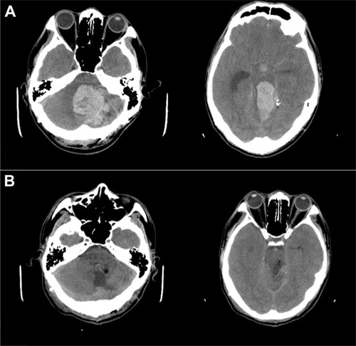 Figure 1 CT findings of the brain. (A) Left cerebellar hemorrhage and brainstem hemorrhage with IVH shown in the preoperational CT. (B) Encephalomalacia change in the left cerebellum and midbrain (30 days after the emergent operation).