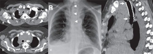 Figure 4 Example of palliative tracheal stenting. (a) A 67-year-old female with metastatic breast cancer and extensive mediastinal lymphadenopathy severely compressing and displacing the trachea (white arrow). (b) axial CT image, (c) plain chest X-ray, and (d) sagittal reformatted CT image show a self-expanding uncovered stent (Pyramed, Esher, United Kingdom) deployed in the trachea to restore luminal patency and avoid suffocation.