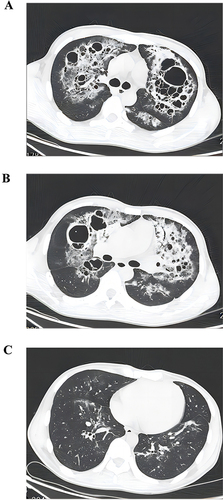 Figure 1 The chest HRCT scan from July 26, 2022, taken at the time of initial diagnosis, shows the patient’s lungs with multiple nodular opacities, patchy areas, and honeycombing, predominantly in the upper lobes, characterized by uneven densities and some areas showing lucencies and bronchial images. (A) Tracheal bifurcation level: honeycomb of different sizes and infiltrating patchy shadows can be seen in most areas, with the honeycomb as the main change, (B) The bronchial level of the right middle segment: septal thickening with nodular infiltrates and honeycomb of different sizes, more septal thickening with nodular infiltrates than honeycomb, (C) The bronchial level of the basal segment: The local infiltration shadow was visible in a small area, and the honeycomb was not obvious.