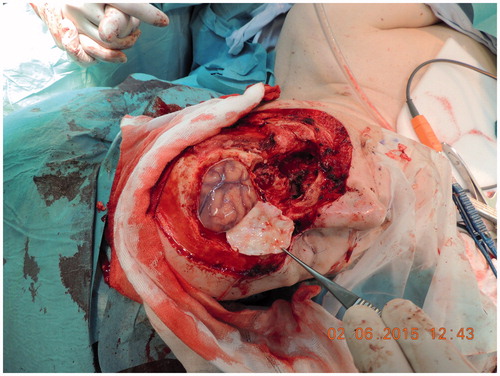 Figure 3. Patient during surgery. Pathological thickened dura mater removed.