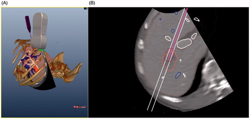 Figure 4. The interactive GUI of the simulation MWA: (A) 3D model scene, (B) simulation ultrasound image of the resampling CT image.