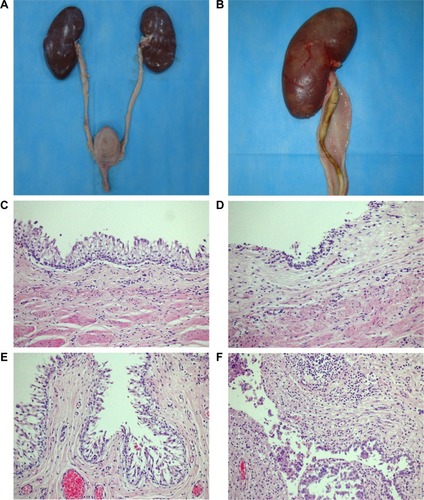 Figure 7 Representative macroscopic and microscopic images of the urinary tract: (A) the poly(ε-caprolactone) (PCL)/poly(lactide-co-glycolide) (PLGA) stent-treated pig on Day 70 after insertion showing no dilatation of renal pelvis or ureter; (B) the Shagong® stent-grafted pig at 70 days after insertion showing a massively calcified stent and a dilated ureter; representative histopathological microimages of tissue slides revealing (C) normal epithelium (PCL/PLGA stent) and (D) inflammatory cell infiltration (Shagong® stent) of the renal pelvis; representative histopathological microimages showing (E) normal epithelium (PCL/PLGA stent) and (F) severe inflammation of the ureter (Shagong® stent) on Day 70.Note: Magnification is ×200 in (C–F).