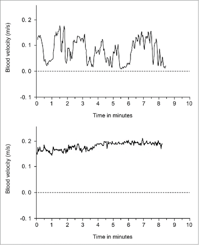 Figure 7. Blood velocity in the right dorsalis pedis artery of a woman during labor, but between contractions. Upper panel: Fluctuations typical of temperature regulation in a fairly warm delivery room. Lower panel: Same woman in the same environment after epidural block. (Graphs from unpublished recordings obtained during the investigations described in JanbuCitation22).