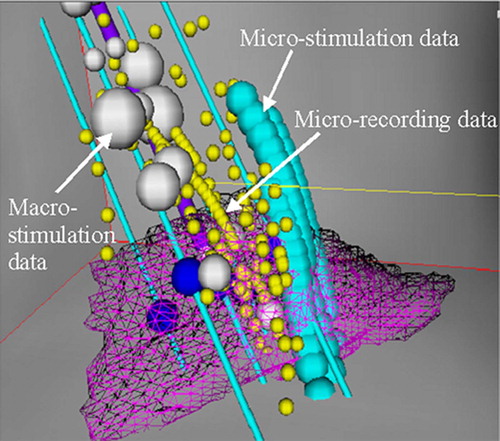 Figure 2. The magnified version of Figure 1. The purple line in the center represents the central electrodes. The cyan lines parallel to the central line represent surgical trajectories. The small yellow spheres represent micro-recording data, the larger cyan spheres micro-stimulation data, and the still larger white spheres macro-stimulation data. The mesh object is the sub-thalamic nucleus (STN); the segmented STN and electrophysiological data are non-rigidly registered from the standard brain space to the patient brain image. [Color version available online.]