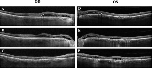 Figure 6. Macular OCT on initial presentation of Patient 2. A-C. in the right eye, OCT showed IRF with hard exudates in nasal macula and peripapillary region, multifocal disruption of ellipsoid zones and RPE irregularity. D-F. in the left eye, OCT showed IRF with hard exudates mostly in nasal macula and peripapillary region, SRF under fovea, multifocal disruption of ellipsoid zones and RPE irregularity.