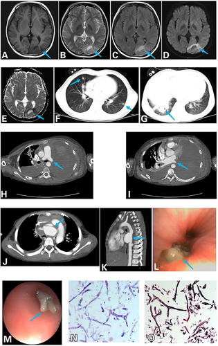 Figure 1 (A–E) Magnetic resonance imaging of patient No. 2. (A) The left occipital lobe showed an irregular gyrus with an abnormal signal shadow and a low signal on T1WI (arrow). (B) Slightly high signal on T2WI (arrow). (C) Slightly high signal on FLAIR (arrow). (D) Limited DWI diffusion (arrow). (E) Limited DWI diffusion (arrow). (F) Computed tomography (CT) of patient No. 1 showing multiple pulmonary nodules and marginal halo sign (arrow). (G) Computed tomography (CT) of patient No. 1 showing air crescent sign (arrow). (H) Enhanced CT of patient No. 3 showing left pulmonary artery occlusion, left atelectasis and left pleural effusion (arrow). (I) Enhanced CT of patient No. 3 showing left pulmonary vein occlusion (arrow). (J) Enhanced CT of patient No. 1 showing aortic arch dissection with ruptured pseudoaneurysm (arrow). (K) Enhanced CT of patient No. 4 showing a pseudoaneurysm of the descending aorta (arrow). (L) Bronchoscope of patient No. 4 showing a grayish-brown necrotic mass occluding the middle lobe of the right lung (arrow). (M) Bronchoscope of patient No. 1 showing a gelatinous substance occluded the base lobe of the left lower lung (arrow). (N) Alveolar lavage fluid pathology of patient No. 3 showing typical hyphal morphology. Mucorales hyphae were at least 6–16 µm wide, ribbon-like, pauci-septate, with subrectangular branching (HE 20X). (O) Alveolar lavage fluid pathology of patient No. 3 showing typical hyphal morphology. Mucorales hyphae were at least 6–16 µm wide, ribbon-like, pauci-septate, with subrectangular branching (PASM 20X).