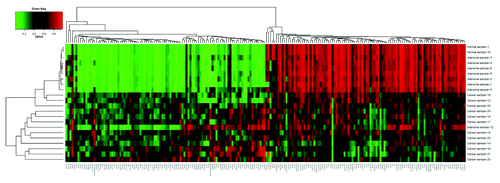 Figure 1. Cluster profile analysis of colonic samples. Using the IHM27, we generated the methylation profiles of 12 cancers, 8 adenomas and 2 normal colonic tissues. A clustering of the different samples based on their methylome profiles led to a clear resolution between the cancer samples and the adenomas. The normal tissue clustered with the adenomas. With the exception of one adenoma (tubuvillus type) all the cancer samples was clustered together.