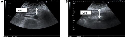 Figure 2 Abdominal ultrasound showing the thickness from the inner surface of the rectus abdominis muscle to the anterior wall of the aorta: (A) the thickness is 27.2 mm; (B) the thickness is 56.4 mm. VFT, visceral fat thickness.