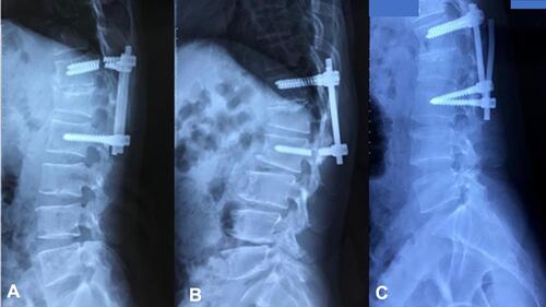 Figure 2 Implant failure: (A) breakage of pedicle screws above the fracture level; (B) breakage of pedicle screws below the fracture level; (C) rod pull out of the pedicle screw head.