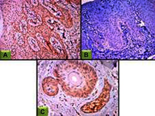 Figure 3 JAK1 expression in lesional skin sections.