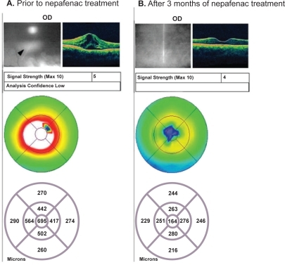 Figure 1 Recalcitrant uveitic CME: Patient #1 OCT images. A) The patient shows retinal edema and cystoid spaces (see arrow), with a retinal thickness of 695 μm prior to nepafenac treatment. B) The patient shows resolution of retinal edema, with a retinal thickness of 164 μm after three months of nepafenac treatment.