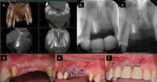 Figure 3. (a, b) Periapical radiograph and CBCT showing apical healing and loss of coronal bone graft; (c) Post-operative radiograph of re-surgery; (d) Sinus tract on the buccal gingiva of tooth #8 and soft tissue opening on the alveolar ridge; (e) Suturing after re-surgery; (f) Provisional FPD after re-surgery.