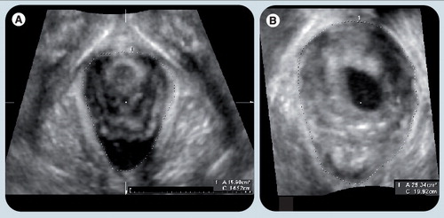 Figure 12. The effect of levator avulsion on hiatal dimensions.Antepartum and postpartum ultrasound images (single-slice axial planes in the plane of minimal hiatal dimensions) of a patient with left-sided avulsion after forceps delivery. (A) The hiatal area on maximum Valsalva at 38 weeks was 15.6 cm2. (B) It was measured at 29.3 cm2 at 4 months postpartum.Reproduced with permission fromCitation[61].