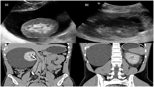 Figure 4. Gray-scale ultrasound image (a) of right kidney showing anechoiec collection in perinephric region and (b) left kidney showing multi septated anechoic collection in perinephric region. (c) CT scan arterial phase in coronal plane showing nonenhancing collection (d) MPR reformation of coronal plane of delayed phase of CT scan abdomen showing normal excretion of contrast.