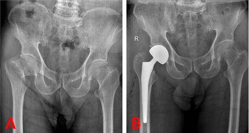 Figure 2 (A) Pre x-ray before right Hip arthroplasty; (B) The x-ray after right Hip arthroplasty.