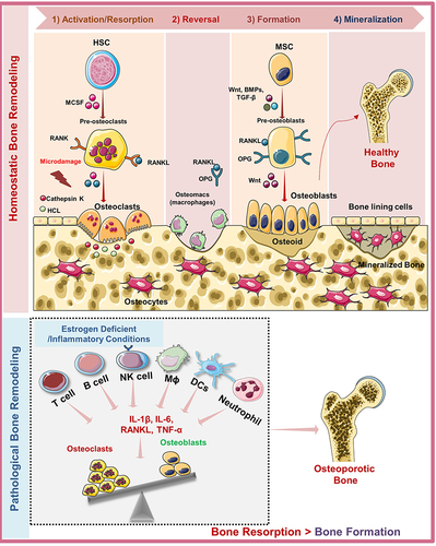 Figure 1 Bone Remodeling Cycle under physiological and pathological condition: The remodeling process is characterized by a sequential series of four phases: 1) Activation and Resorption phases, which is governed by the systemic concentration of RANKL and M-CSF that induce the differentiation of hematopoietic stem cells (HSCs) derived OC precursors into mature multinucleated OCs. In resorption phase, mature osteoclasts with unique ruffled border induce resorption of bone by secreting cathepsin K, H+, and Cl− in sealing zone and after resorption detaches from the bone surface and undergoes apoptosis (programmed cell death mechanism). 2) Reversal phase: mesenchymal derived OBs differentiate in the presence of Wnt, BMPs, and TGF-β and are recruited to the resorbed site. 3) Formation phase: OBs lay down the new organic bone matrix which ultimately undergoes 4) Mineralization phase. Under estrogen deficient conditions or inflammatory conditions, RANKL is also provided by other immune cells that lead to enhancement in osteoclastogenesis and thus more bone resorption which ultimately leads to osteoporosis.