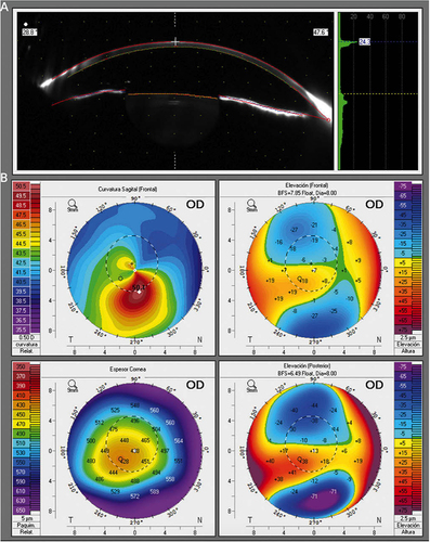 Figure 1 (A) Scheimpflug image in a keratoconus patient. (B) Axial (power) map, anterior and posterior elevation maps, and global pachymetry map in a keratoconus patient.