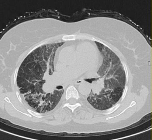 Figure 1 HRCT of chest for patient with fibrosis.