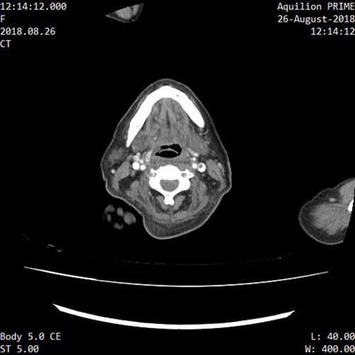 Figure 4 CECT neck showing non-occluding filling defect in left internal jugular vein.