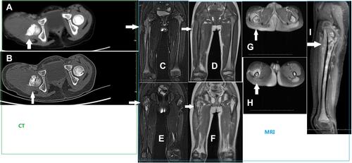 Figure 4 Representative imaging results from case 4 in Table 1. (A and B) CT scans showing significant bone destruction. The white arrow indicates obvious bone destruction in the upper femur. (C–I) Simultaneous magnetic resonance images showing serious bone destruction and soft tissue swelling. The white arrow indicates bone destruction and soft tissue swelling in the upper femur.