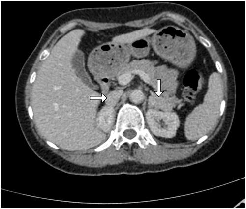 Figure 1. Adrenal enhancement CT showed, post-operative bilateral adrenal review, a soft tissue image of 19 mm × 7 mm in the adrenal areas on the right and a 16 mm × 33 mm on the left.