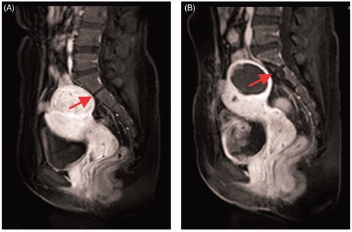 Figure 1. CE-MRI before and after USgHIFU ablation: (A) sacrum shows normal before treatment; (B) sacrum shows non-perfused upon CE-MRI immediately after treatment.