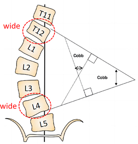 Figure 2 Cobb angle method for waist measurement.