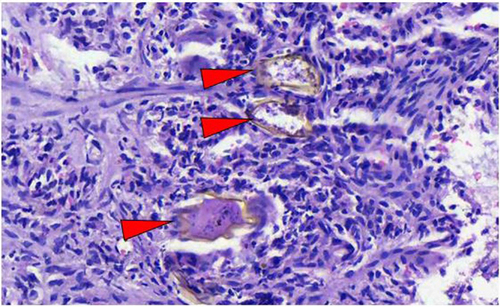 Figure 5 High power photomicrograph revealing eggs of S. mansoni (red arrow heads) surrounded by mononuclear inflammatory cells in the lamina propria.