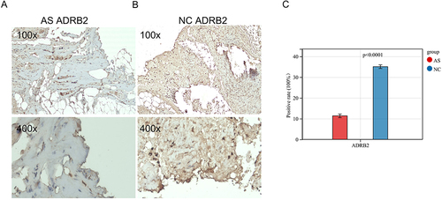 Figure 12 Immunohistochemistry of ADRB2 in ISL: (A and B) The expression of ADRB2 in ISL. (C) The data visualization of ADRB2 positivity rate results (AS: AS-KD group, NC: control group).