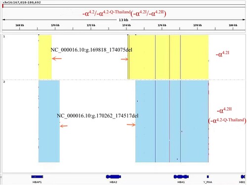 Figure 3. TGS identified two different 4.2 kb deletions in the patient, namely -α4.2Ⅰ and -α4.2Ⅱ.