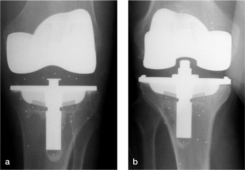 Figure. Antero-posterior radiograph of an MB (a) and a PS (b) total knee prosthesis as used in this study.