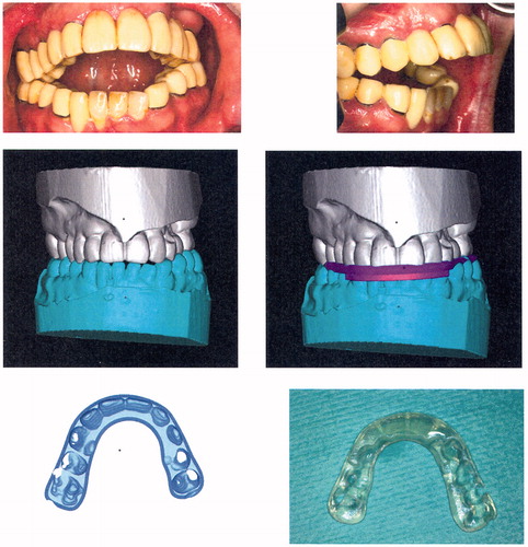 Figure 3. Top row: Preoperative clinical situation in patient 2, a young male affected by amelogenesis imperfecta causing a severe skeletal open bite, after insertion of fixed prosthodontic bridgework. Middle row: Virtual surgery and splint design by RapidSplint: both jaws were repositioned in order to close the open bite and correct dental midlines, and a virtual splint (pink) was designed accordingly. Bottom row: Virtual splint as an .stl-file (left) and after fabrication (right) by 3D printing technology (FullCure™ 720; PolyJet™).