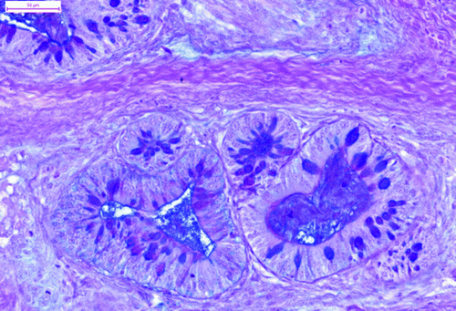 Figure 2.  The glandular structures with numerous goblet cells (Alcian blue-PAS). Bar = 50 μm.
