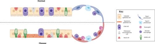 Figure 1 Epithelial differences between normal and diseased small airways. Ciliated, cuboidal epithelial cells constitute the majority of a normal bronchiolar epithelium. In a diseased SAE, however, these cell types undergo metaplasia and become a more squamous phenotype. Secretory goblet cells are found in small numbers within a normal SAE, but under diseased conditions, increase in prevalence. By contrast, the number of secretory club cells are reduced in a diseased SAE, compared to normal, with a subsequent reduction in the secretion of the protective protein, CC-16. Their proposed progenitor cell, the basal cell, is however present in greater abundance in a diseased epithelium, compared to normal.