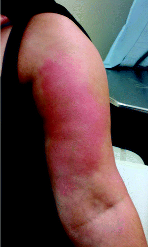 Figure 1. Left arm of patient 4 showing erythema of the upper arm where she received the PS23 and influenza vaccines 5 d prior. Patient’s consent was obtained to publish the picture.