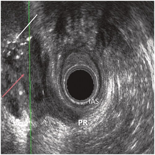 Figure 3. Inflammation was noted as a slightly hyperechogenic area (red arrow) at 3D EAUS in multiplanar reconstruction after the AFP procedure. Strongly hyperechogenic dots (white arrow) represent gas bubbles in the fistula tract. IAS: internal anal sphincter; PR: puborectalis muscle.