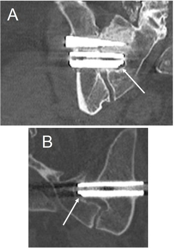 Figure 7 Coronal CT images at 5 years demonstrating radiolucency. (A) A small amount of radiolucency is present around the medial aspect of the middle implant (white arrow) in the right sacroiliac joint. (Note: third implant is out of plane, on a different slice.) Also noted is positive bony remodeling in the sacrum around the superior implant. (B) A second patient with radiolucency (white arrow) around the inferior implant at the left sacroiliac joint. Note the implant is short (i.e., not adequately engaged) in the sacrum.