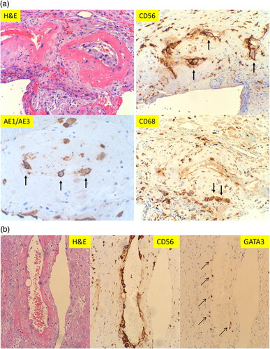 Figure 2. Morphologic features of classic decidual vasculopathy of preeclamptic placentas from the decidua basalis with immunohistochemical staining for CD56, AE1/AE3 and CD68 expressions. (A) Classic decidual vasculopathy with acute atherosis and fibrinoid medial necrosis by hematoxylin & eosin (H&E) stain. The same section of placenta as in H&E panel with CD56, AE1/AE3 and CD68 immunostaining. (All at 400× magnification). Arrows indicate positive reactivity to individual markers. (B) Decidual vasculopathy with immunostaining for CD56 and GATA3. Partial involvement of spiral artery wall by fibrinoid medial necrosis and acute atherosis in panel H&E stain. Adjacent space is an endometrial gland. The same vasculopathy as in H&E panel with immunostaining for CD56 and GATA3 (nuclear signal). All at 200× magnification.