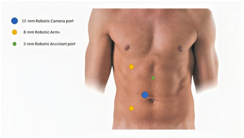 Figure 3 Robotic pyeloplasty trocars’ placement.