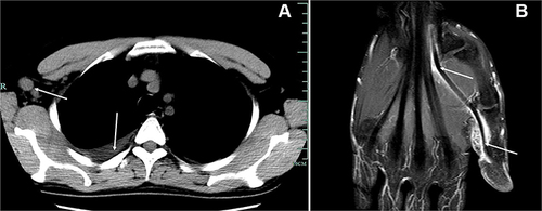 Figure 2 (A)CT scan of the chest shows multiple enlarged lymph nodes in the right axilla and right pleural effusion (white arrows). (B) MRI of the right hand shows an abnormal signal on the palmar side of the first proximal phalangeal bone of the right hand. T2W1 shows high signal intensity. The lesion extends along the tendon sheath of the flexor tendon into the carpal canal.