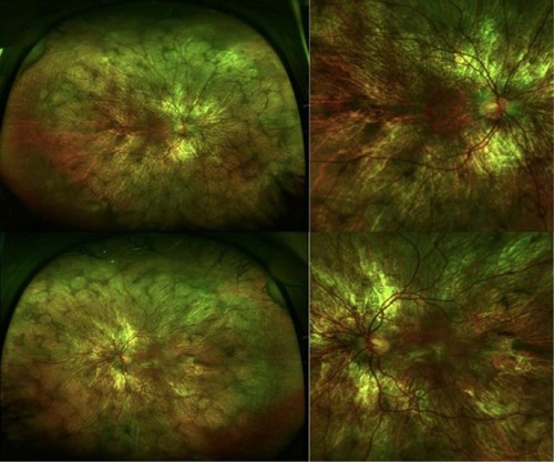 Figure 1 Ultra-wide field color fundus photograph of the right and left eye depicting diffuse midperipheral chorioretinal atrophy with sparing of the central macula.